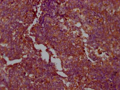 IHC image of CSB-RA632595A0HU diluted at 1:100 and staining in paraffin-embedded human lung cancer performed on a Leica BondTM system. After dewaxing and hydration, antigen retrieval was mediated by high pressure in a citrate buffer (pH 6.0). Section was blocked with 10% normal goat serum 30min at RT. Then primary antibody (1% BSA) was incubated at 4℃ overnight. The primary is detected by a Goat anti-rabbit IgG polymer labeled by HRP and visualized using 0.05% DAB.