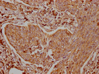 IHC image of CSB-RA786226A0HU diluted at 1:100 and staining in paraffin-embedded human cervical cancer performed on a Leica BondTM system. After dewaxing and hydration, antigen retrieval was mediated by high pressure in a citrate buffer (pH 6.0). Section was blocked with 10% normal goat serum 30min at RT. Then primary antibody (1% BSA) was incubated at 4℃ overnight. The primary is detected by a Goat anti-rabbit IgG polymer labeled by HRP and visualized using 0.05% DAB.