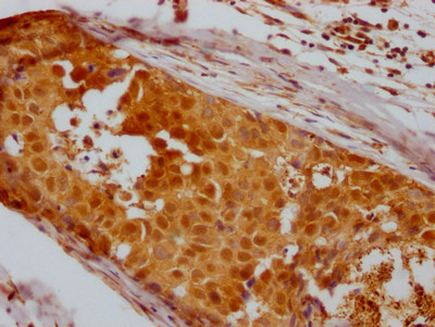 IHC image of CSB-RA593846A0HU diluted at 1:100 and staining in paraffin-embedded human breast cancer performed on a Leica BondTM system. After dewaxing and hydration, antigen retrieval was mediated by high pressure in a citrate buffer (pH 6.0). Section was blocked with 10% normal goat serum 30min at RT. Then primary antibody (1% BSA) was incubated at 4℃ overnight. The primary is detected by a Goat anti-rabbit IgG polymer labeled by HRP and visualized using 0.05% DAB.