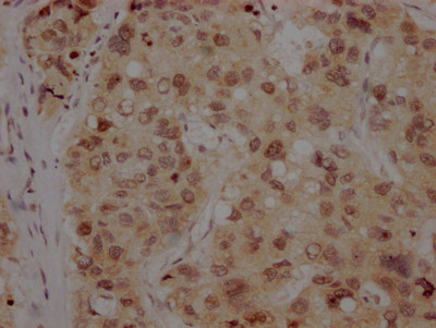 IHC image of CSB-RA916472A0HU diluted at 1:100 and staining in paraffin-embedded human liver cancer performed on a Leica BondTM system. After dewaxing and hydration, antigen retrieval was mediated by high pressure in a citrate buffer (pH 6.0). Section was blocked with 10% normal goat serum 30min at RT. Then primary antibody (1% BSA) was incubated at 4℃ overnight. The primary is detected by a Goat anti-rabbit IgG polymer labeled by HRP and visualized using 0.05% DAB.