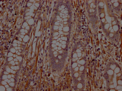 IHC image of CSB-RA272100A0HU diluted at 1:100 and staining in paraffin-embedded human colon cancer performed on a Leica BondTM system. After dewaxing and hydration, antigen retrieval was mediated by high pressure in a citrate buffer (pH 6.0). Section was blocked with 10% normal goat serum 30min at RT. Then primary antibody (1% BSA) was incubated at 4℃ overnight. The primary is detected by a Goat anti-rabbit IgG polymer labeled by HRP and visualized using 0.05% DAB.