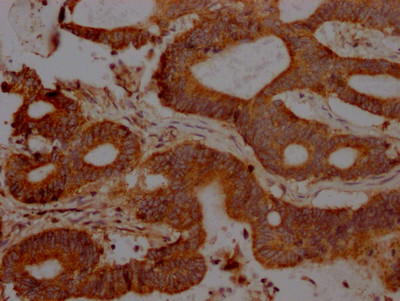 IHC image of CSB-RA252392A0HU diluted at 1:100 and staining in paraffin-embedded human colon cancer performed on a Leica BondTM system. After dewaxing and hydration, antigen retrieval was mediated by high pressure in a citrate buffer (pH 6.0). Section was blocked with 10% normal goat serum 30min at RT. Then primary antibody (1% BSA) was incubated at 4℃ overnight. The primary is detected by a Goat anti-rabbit IgG polymer labeled by HRP and visualized using 0.05% DAB.