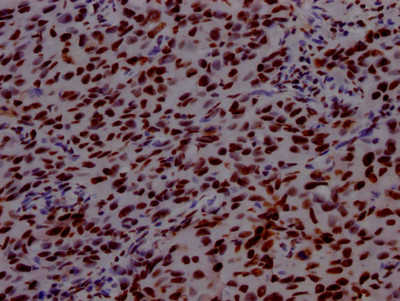 IHC image of CSB-RA569290A0HU diluted at 1:100 and staining in paraffin-embedded human bladder cancer performed on a Leica BondTM system. After dewaxing and hydration, antigen retrieval was mediated by high pressure in a citrate buffer (pH 6.0). Section was blocked with 10% normal goat serum 30min at RT. Then primary antibody (1% BSA) was incubated at 4℃ overnight. The primary is detected by a Goat anti-rabbit IgG polymer labeled by HRP and visualized using 0.05% DAB.