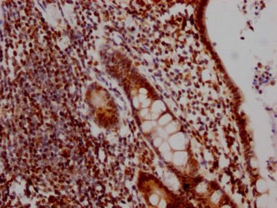 IHC image of CSB-RA231179A0HU diluted at 1:100 and staining in paraffin-embedded human colon cancer performed on a Leica BondTM system. After dewaxing and hydration, antigen retrieval was mediated by high pressure in a citrate buffer (pH 6.0). Section was blocked with 10% normal goat serum 30min at RT. Then primary antibody (1% BSA) was incubated at 4℃ overnight. The primary is detected by a Goat anti-rabbit IgG polymer labeled by HRP and visualized using 0.05% DAB.