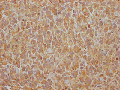 IHC image of CSB-RA794061A0HU diluted at 1:100 and staining in paraffin-embedded human glioma cancer performed on a Leica BondTM system. After dewaxing and hydration, antigen retrieval was mediated by high pressure in a citrate buffer (pH 6.0). Section was blocked with 10% normal goat serum 30min at RT. Then primary antibody (1% BSA) was incubated at 4℃ overnight. The primary is detected by a Goat anti-rabbit IgG polymer labeled by HRP and visualized using 0.05% DAB.