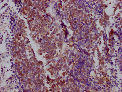 IHC image of CSB-RA181189A0HU diluted at 1:100 and staining in paraffin-embedded human lung cancer performed on a Leica BondTM system. After dewaxing and hydration, antigen retrieval was mediated by high pressure in a citrate buffer (pH 6.0). Section was blocked with 10% normal goat serum 30min at RT. Then primary antibody (1% BSA) was incubated at 4℃ overnight. The primary is detected by a Goat anti-rabbit IgG polymer labeled by HRP and visualized using 0.05% DAB.