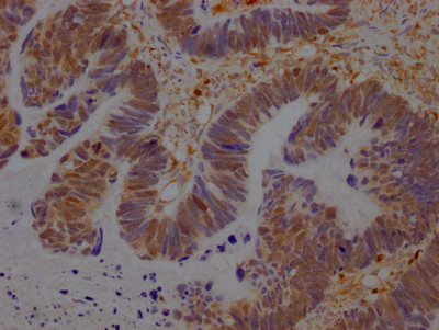 IHC image of CSB-RA981267A0HU diluted at 1:100 and staining in paraffin-embedded human ovarian cancer performed on a Leica BondTM system. After dewaxing and hydration, antigen retrieval was mediated by high pressure in a citrate buffer (pH 6.0). Section was blocked with 10% normal goat serum 30min at RT. Then primary antibody (1% BSA) was incubated at 4℃ overnight. The primary is detected by a Goat anti-rabbit IgG polymer labeled by HRP and visualized using 0.05% DAB.