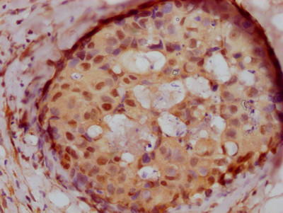 IHC image of CSB-RA999292A0HU diluted at 1:100 and staining in paraffin-embedded human breast cancer performed on a Leica BondTM system. After dewaxing and hydration, antigen retrieval was mediated by high pressure in a citrate buffer (pH 6.0). Section was blocked with 10% normal goat serum 30min at RT. Then primary antibody (1% BSA) was incubated at 4℃ overnight. The primary is detected by a Goat anti-rabbit IgG polymer labeled by HRP and visualized using 0.05% DAB.
