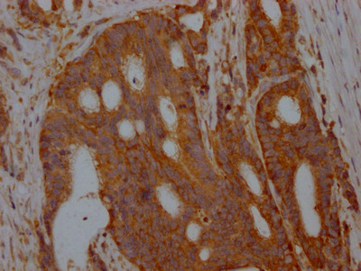 IHC image of CSB-RA571479A0HU diluted at 1:100 and staining in paraffin-embedded human colon cancer performed on a Leica BondTM system. After dewaxing and hydration, antigen retrieval was mediated by high pressure in a citrate buffer (pH 6.0). Section was blocked with 10% normal goat serum 30min at RT. Then primary antibody (1% BSA) was incubated at 4℃ overnight. The primary is detected by a Goat anti-rabbit IgG polymer labeled by HRP and visualized using 0.05% DAB.