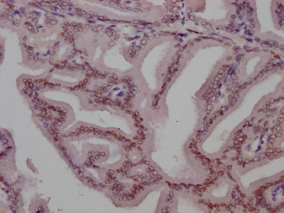 IHC image of CSB-RA243116A0HU diluted at 1:100 and staining in paraffin-embedded human prostate tissue performed on a Leica BondTM system. After dewaxing and hydration, antigen retrieval was mediated by high pressure in a citrate buffer (pH 6.0). Section was blocked with 10% normal goat serum 30min at RT. Then primary antibody (1% BSA) was incubated at 4℃ overnight. The primary is detected by a Goat anti-rabbit IgG polymer labeled by HRP and visualized using 0.05% DAB.