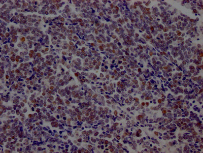 IHC image of CSB-RA877322A0HU diluted at 1:100 and staining in paraffin-embedded human lung cancer performed on a Leica BondTM system. After dewaxing and hydration, antigen retrieval was mediated by high pressure in a citrate buffer (pH 6.0). Section was blocked with 10% normal goat serum 30min at RT. Then primary antibody (1% BSA) was incubated at 4℃ overnight. The primary is detected by a Goat anti-rabbit IgG polymer labeled by HRP and visualized using 0.05% DAB.