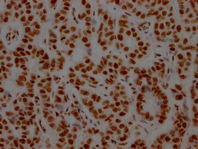 IHC image of CSB-RA273277A0HU diluted at 1:100 and staining in paraffin-embedded human breast cancer performed on a Leica BondTM system. After dewaxing and hydration, antigen retrieval was mediated by high pressure in a citrate buffer (pH 6.0). Section was blocked with 10% normal goat serum 30min at RT. Then primary antibody (1% BSA) was incubated at 4℃ overnight. The primary is detected by a Goat anti-rabbit IgG polymer labeled by HRP and visualized using 0.05% DAB.