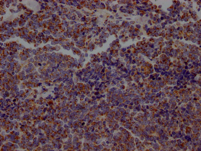 IHC image of CSB-RA218127A0HU diluted at 1:100 and staining in paraffin-embedded human lung cancer performed on a Leica BondTM system. After dewaxing and hydration, antigen retrieval was mediated by high pressure in a citrate buffer (pH 6.0). Section was blocked with 10% normal goat serum 30min at RT. Then primary antibody (1% BSA) was incubated at 4℃ overnight. The primary is detected by a Goat anti-rabbit IgG polymer labeled by HRP and visualized using 0.05% DAB.