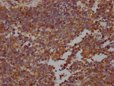 IHC image of CSB-RA188270A0HU diluted at 1:100 and staining in paraffin-embedded human lung cancer performed on a Leica BondTM system. After dewaxing and hydration, antigen retrieval was mediated by high pressure in a citrate buffer (pH 6.0). Section was blocked with 10% normal goat serum 30min at RT. Then primary antibody (1% BSA) was incubated at 4℃ overnight. The primary is detected by a Goat anti-rabbit IgG polymer labeled by HRP and visualized using 0.05% DAB.