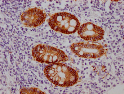 IHC image of CSB-RA245537A0HU diluted at 1:100 and staining in paraffin-embedded human colon cancer performed on a Leica BondTM system. After dewaxing and hydration, antigen retrieval was mediated by high pressure in a citrate buffer (pH 6.0). Section was blocked with 10% normal goat serum 30min at RT. Then primary antibody (1% BSA) was incubated at 4℃ overnight. The primary is detected by a Goat anti-rabbit IgG polymer labeled by HRP and visualized using 0.05% DAB.