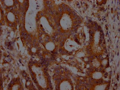 IHC image of CSB-RA634199A0HU diluted at 1:100 and staining in paraffin-embedded human colon cancer performed on a Leica BondTM system. After dewaxing and hydration, antigen retrieval was mediated by high pressure in a citrate buffer (pH 6.0). Section was blocked with 10% normal goat serum 30min at RT. Then primary antibody (1% BSA) was incubated at 4℃ overnight. The primary is detected by a Goat anti-rabbit IgG polymer labeled by HRP and visualized using 0.05% DAB.