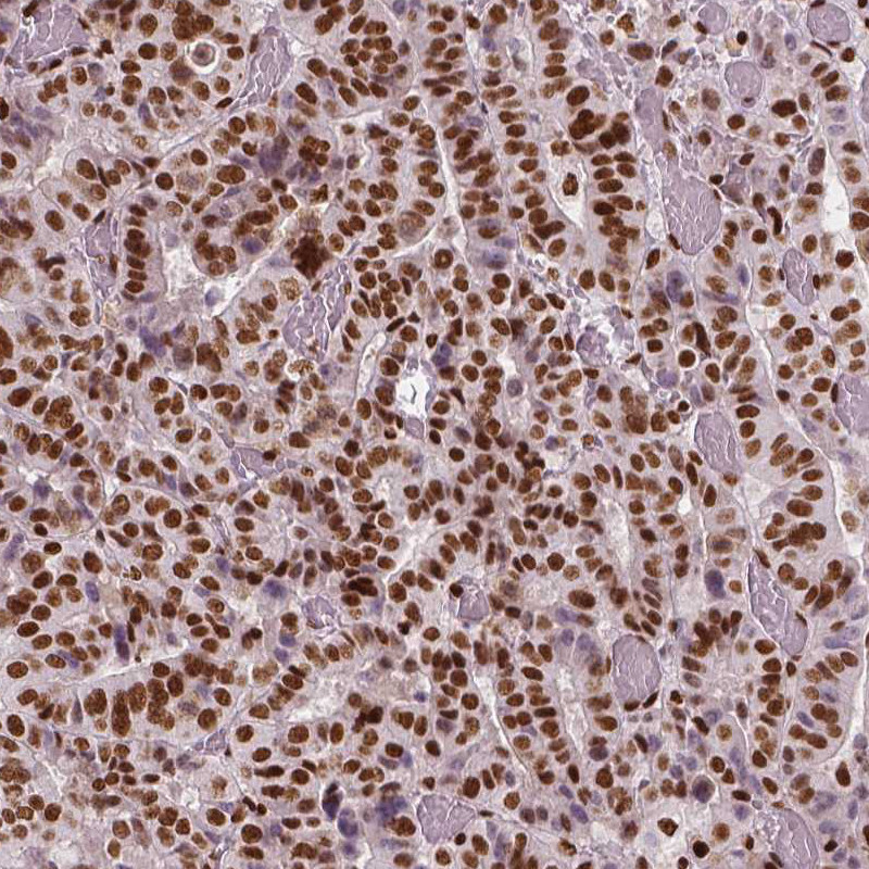 Immunohistochemical staining of human stomach cancer shows moderate to strong nuclear positivity in tumor cells.