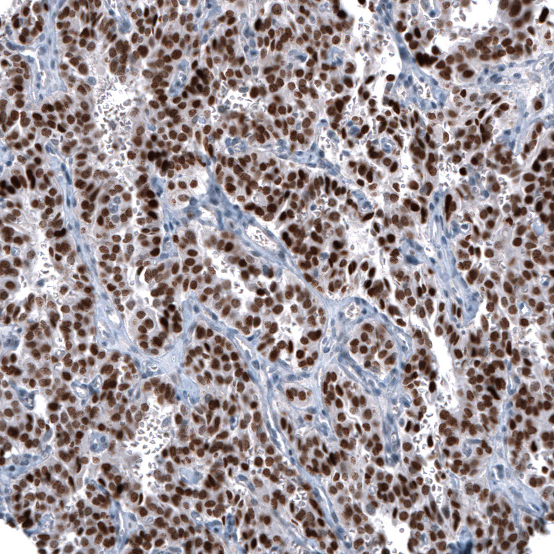 Immunohistochemical staining of human lung tumor (typical carcinoid) shows strong nuclear positivity in tumor cells.