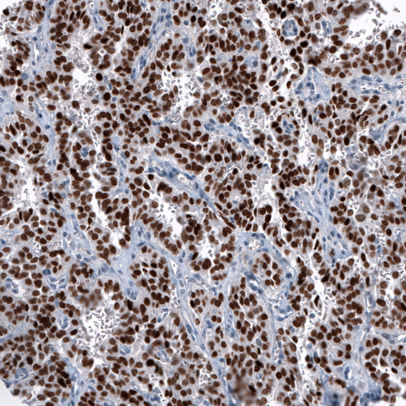 Immunohistochemical staining of human lung tumor (typical carcinoid) shows strong nuclear positivity in tumor cells.