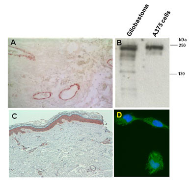 Immunostaining of malignant glioblastoma A) and cutaneous melanoma C) lesions. B) Western blot of whole tissue/cell lysates of a human glioblastoma lesion and the human melanoma A375 cell line after SDS-PAGE under reducing conditions on 4-10% gradient gels. D) Immunostaining of human melanoma MeWo cells. Nuclear counterstaining was performed with Hoescht.