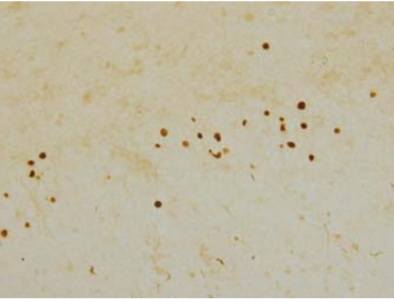 Figure 2. Immunohistochemistry of TDP-43 lesions.pAb pS410 recognizes neuronal cytoplasmic inclusions and dystrophic neurites in dentate gyri of frontotemporal lobar degeneration (FTLD-U).