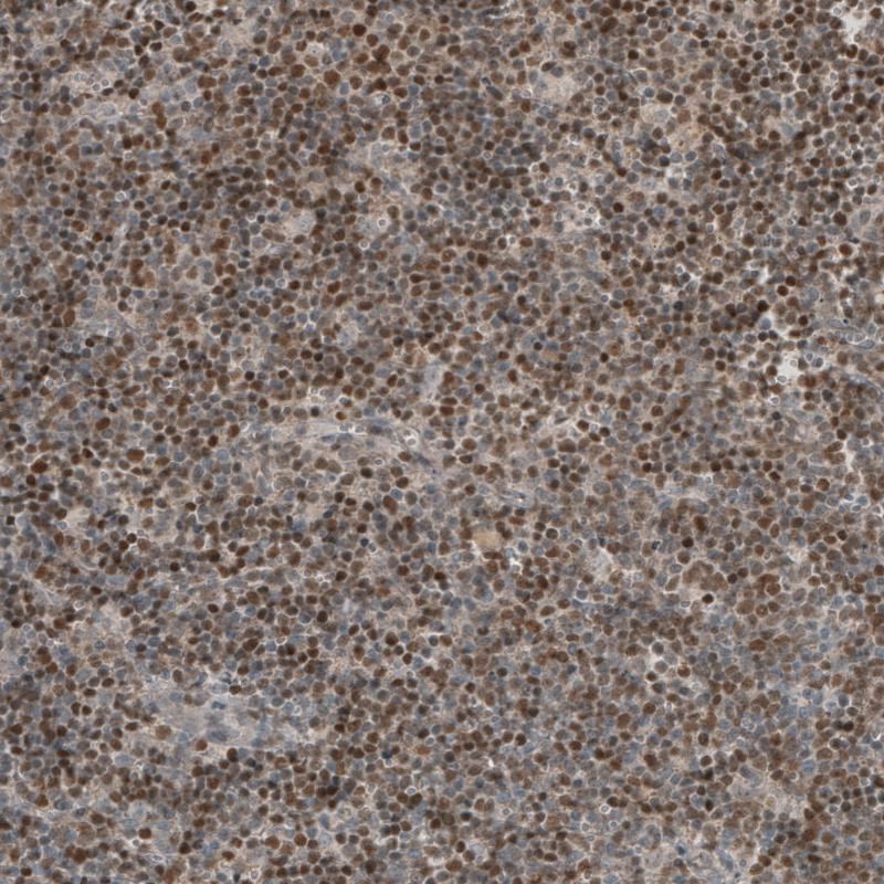 Immunohistochemical staining of human mantle cell lymphoma shows moderate to strong nuclear positivity in tumor cells.