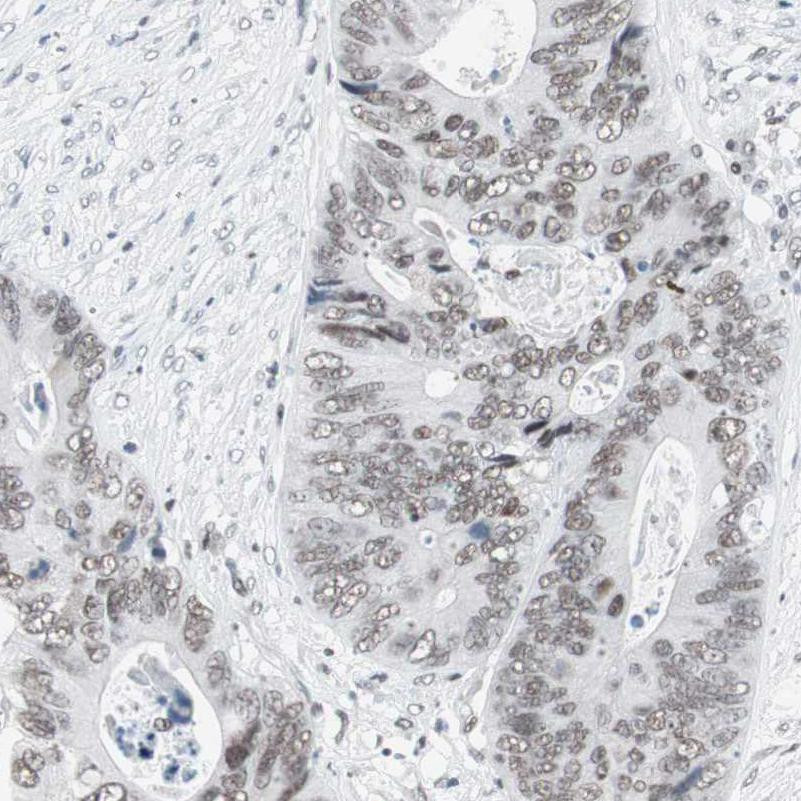 Immunohistochemical staining of human colorectal cancer shows weak to moderate nuclear positivity in tumor cells.