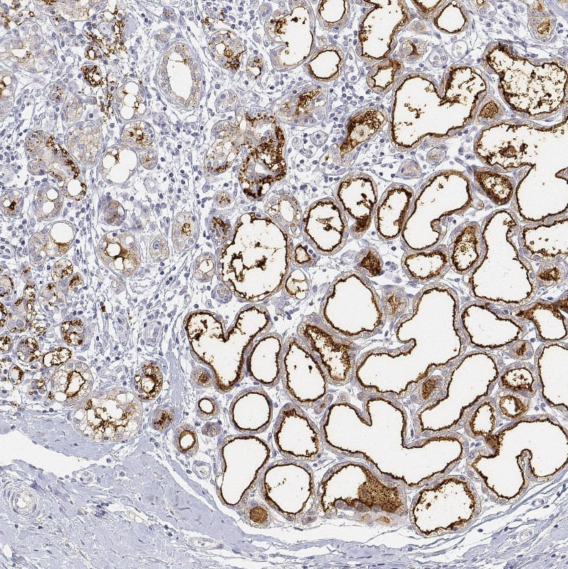 Immunohistochemical staining of human lactating breast shows strong membranous positivity in glandular cells.