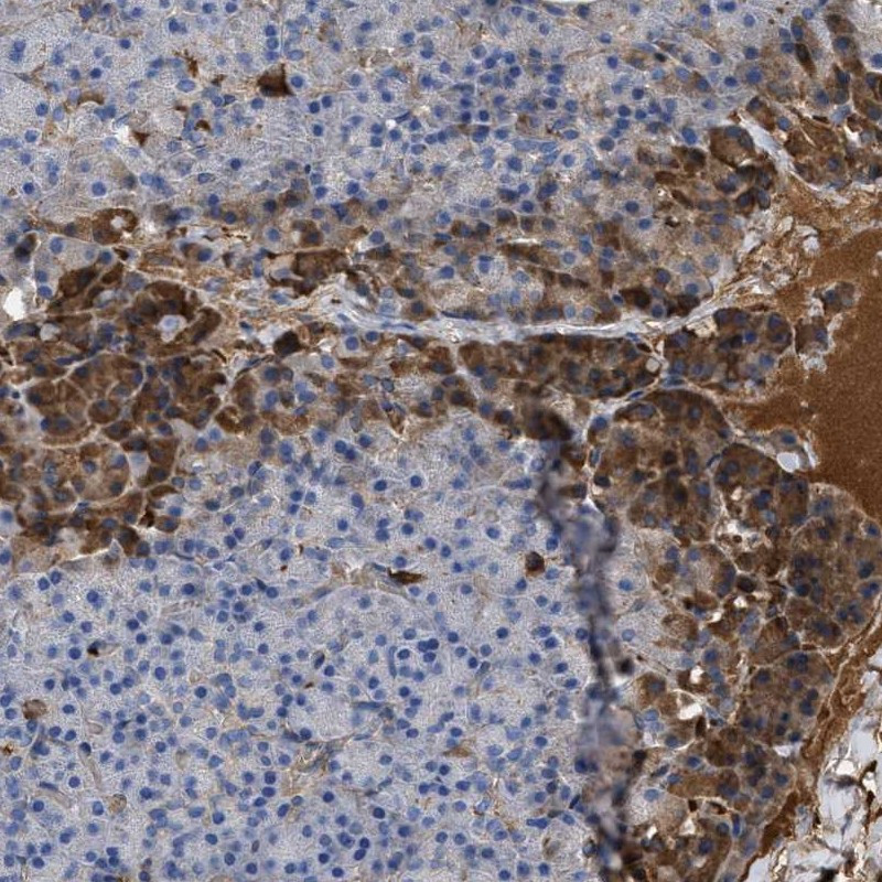 Immunohistochemical staining of human pancreas shows distinct cytoplasmic positivity in exocrine glandular cells along with extracellular material.