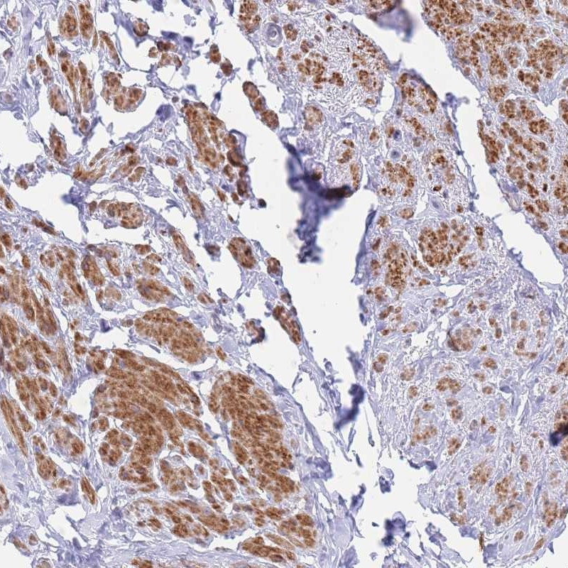 Immunohistochemical staining of human smooth muscle shows strong cytoplasmic positivity in smooth muscle cells.