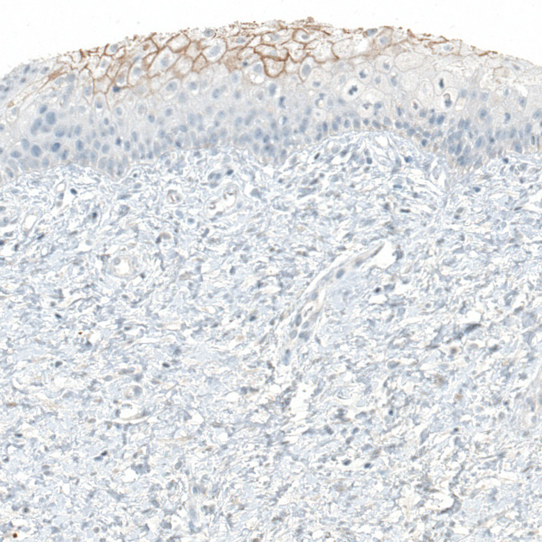Immunohistochemical staining of human cervix, uterine shows membranous positivity in squamous epithelial cells.