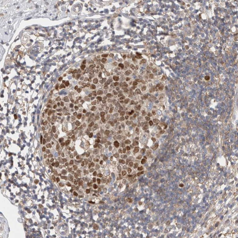 Immunohistochemical staining of human appendix shows strong nuclear positivity in lymphoid reaction center cells.
