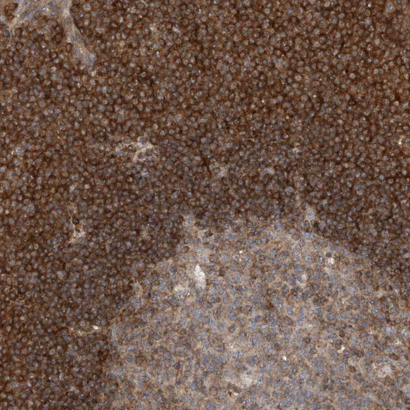 Immunohistochemical staining of human Lymph node shows strong membranous and cytoplasmic positivity in non-germinal center cells.