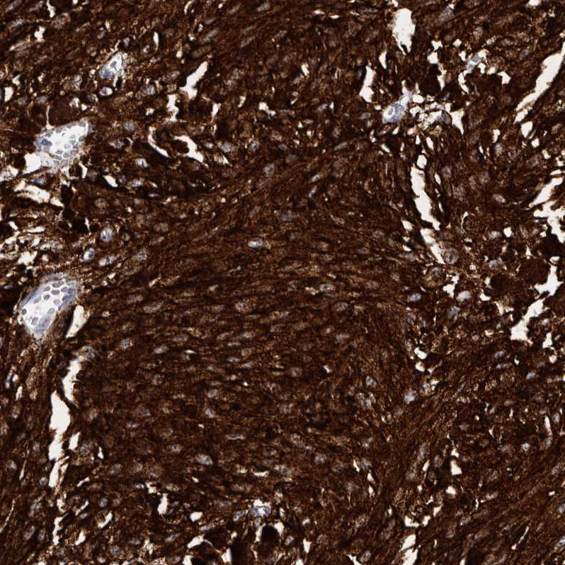 Immunohistochemical staining of human malignant melanoma shows strong cytoplasmic positivity in tumor cells.