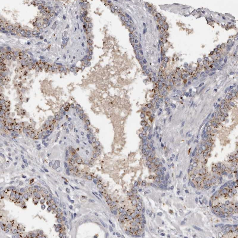 Immunohistochemical staining of human prostate shows moderate granular positivity in glandular cells.
