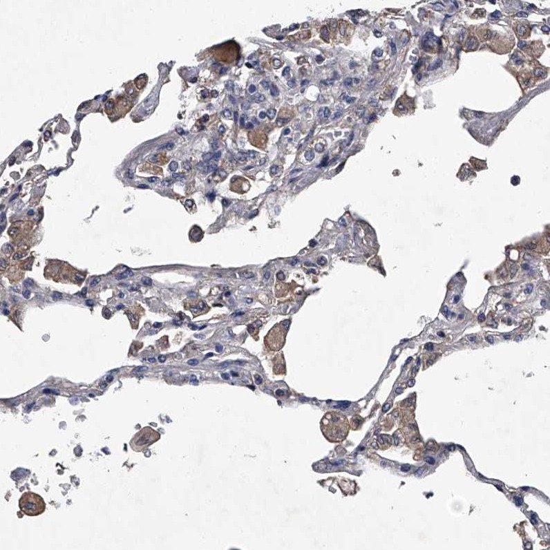 Immunohistochemical staining of human lung shows strong cytoplasmic positivity in macrophages.
