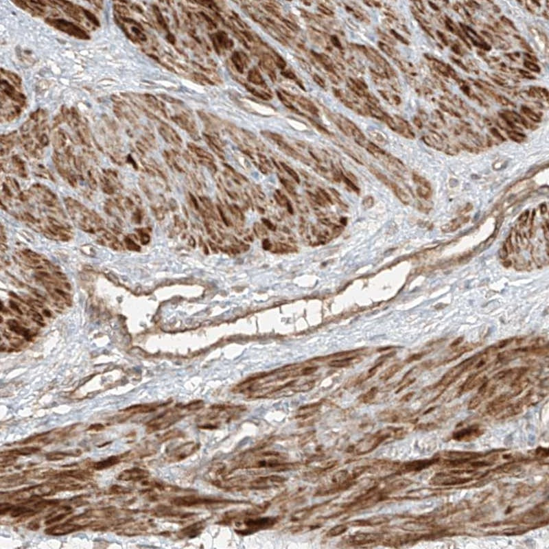 Immunohistochemical staining shows positivity in smooth muscle and endothelial cells.