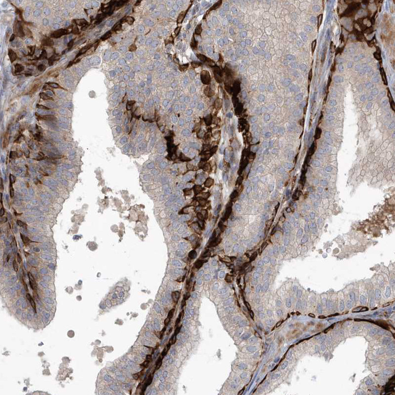 Immunohistochemical staining of human prostate shows strong cytoplasmic positivity in basal cells.