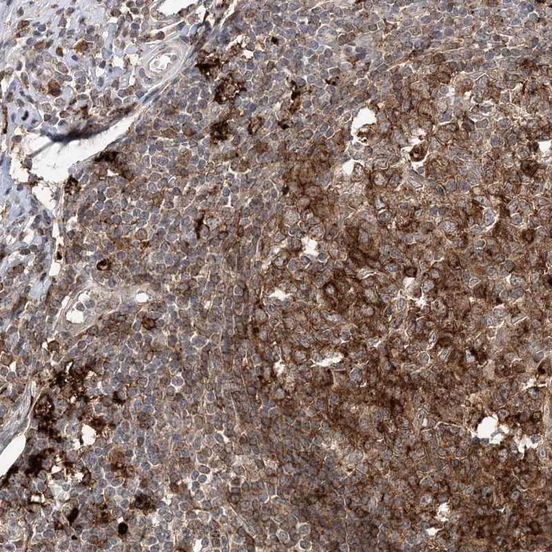 Immunohistochemical staining of human appendix shows strong cytoplasmic positivity in lymphoid cells.