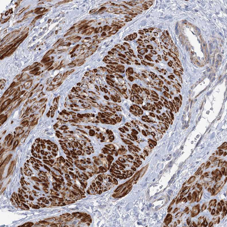 Immunohistochemical staining of human smooth muscle shows strong cytoplasmic positivity in myocytes.