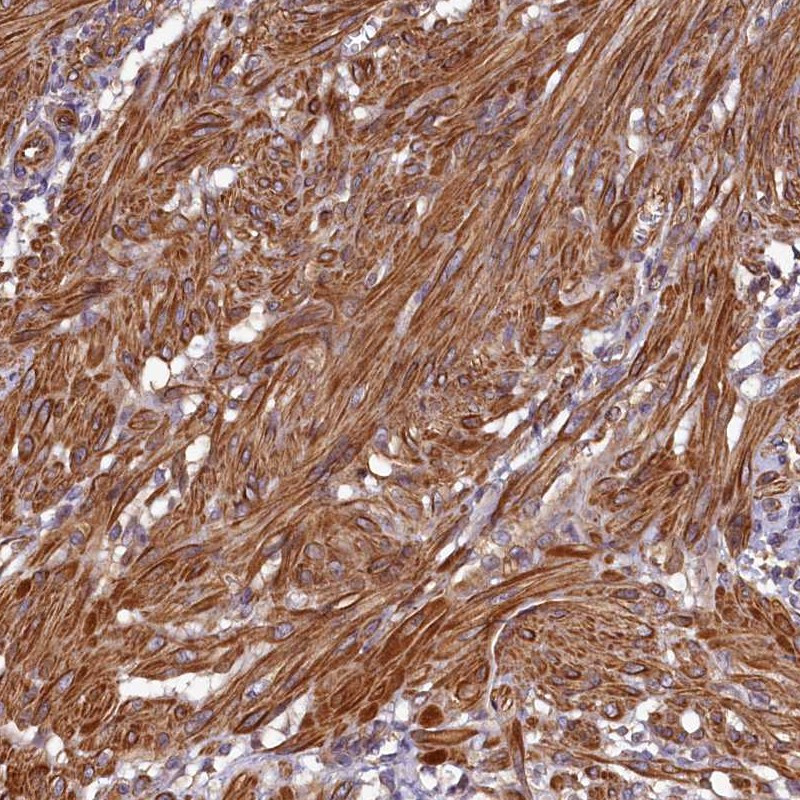 Immunohistochemical staining of human smooth muscle shows cytoplasmic positivity in smooth muscle cells.
