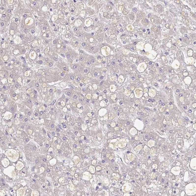 Immunohistochemical staining of human Liver cancer shows moderate extracellular space positivity in tumor cells.