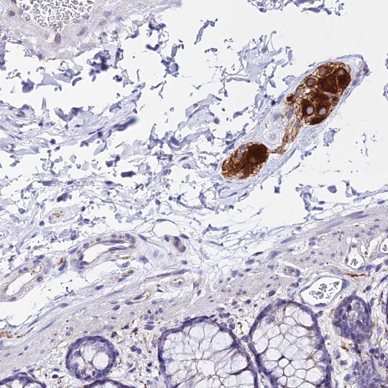 Immunohistochemical staining of human colon shows strong cytoplasmic positivity in ganglion cells.