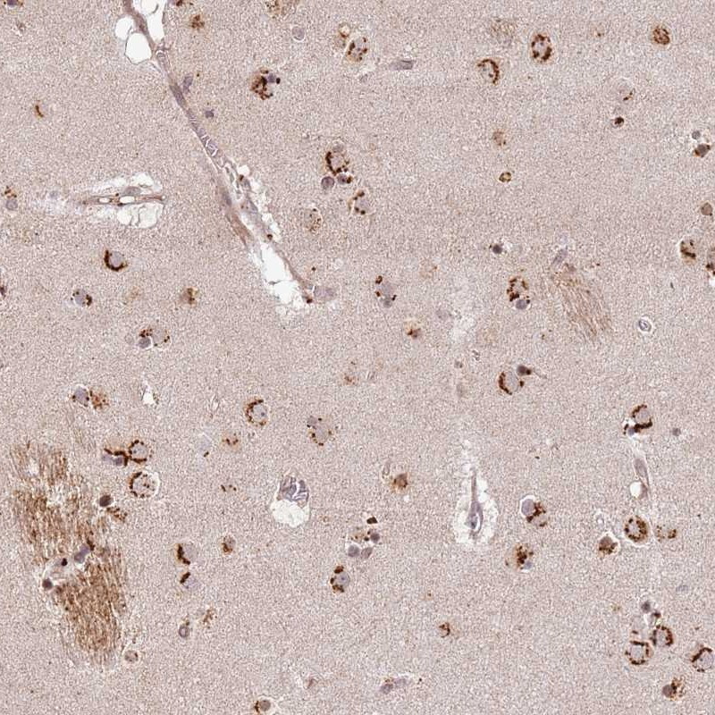 Immunohistochemical staining of human caudate shows strong cytoplasmic positivity in neuronal cells.