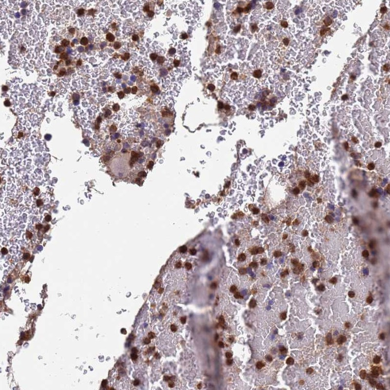 Immunohistochemical staining of human bone marrow shows strong cytoplasmic positivity in hematopoietic cells.