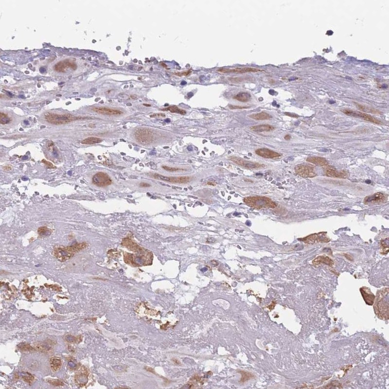 Immunohistochemical staining of human placenta shows cytoplasmic positivity in decidual cells.
