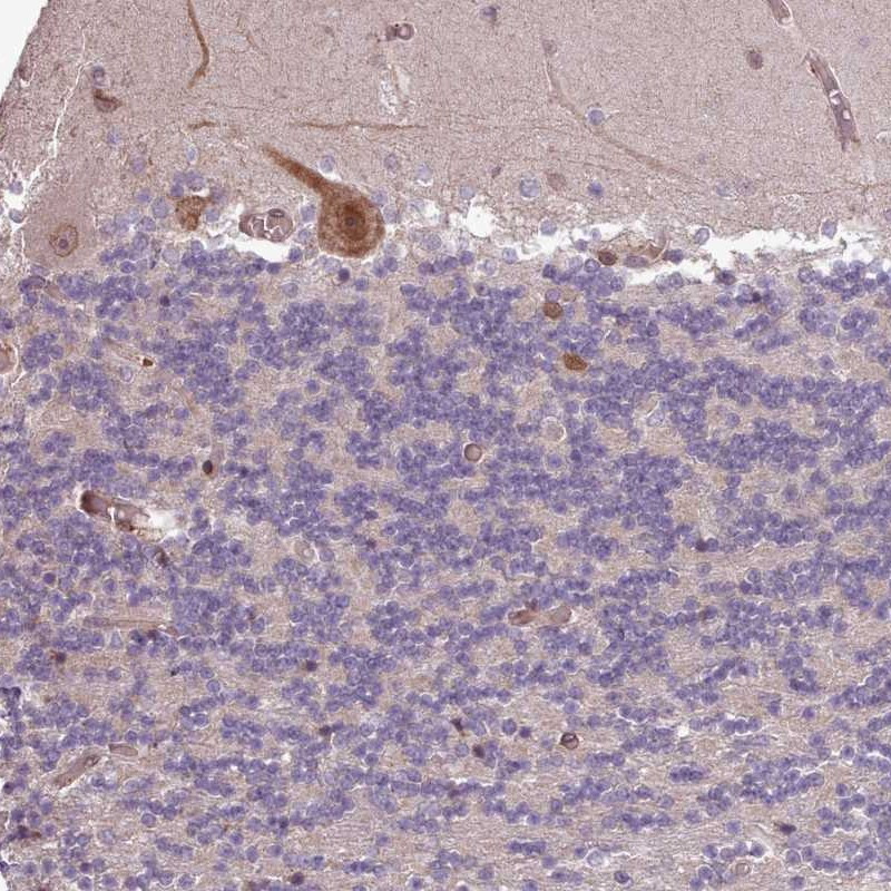 Immunohistochemical staining of human cerebellum shows distinct cytoplasmic and nuclear membranous positivity in Purkinje cells.
