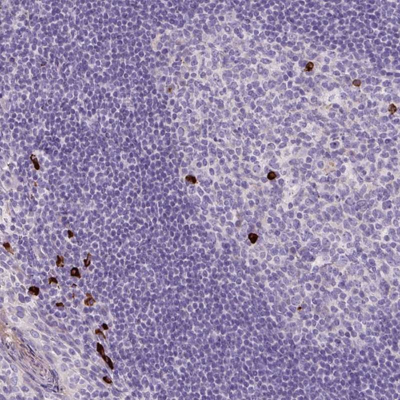 Immunohistochemical staining of human tonsil shows strong cytoplasmic positivity in a subset of germinal and non-germinal center cells.