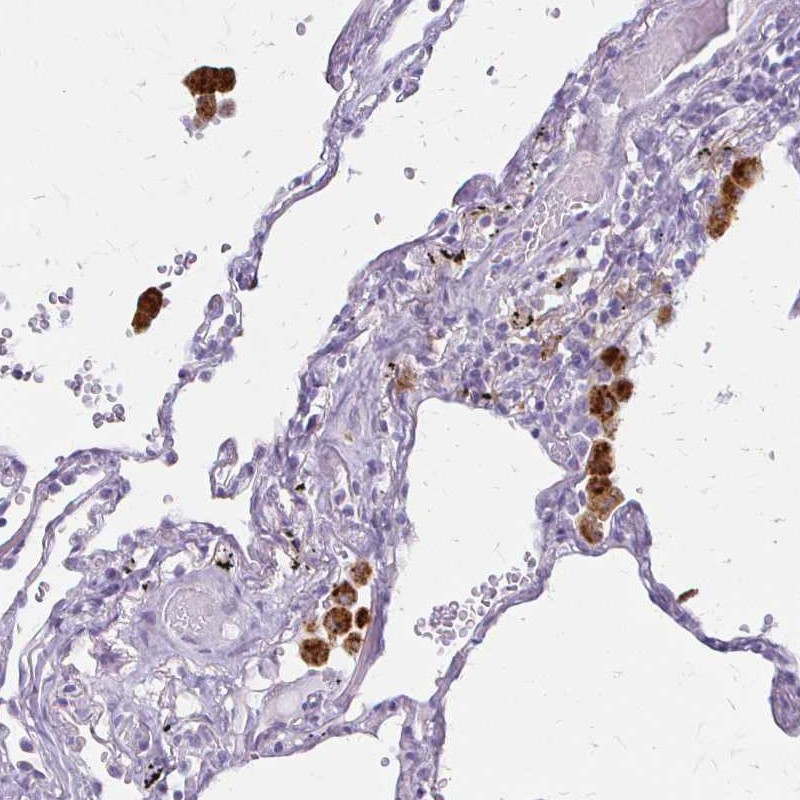 Immunohistochemical staining of human lung shows strong cytoplasmic positivity in macrophages.