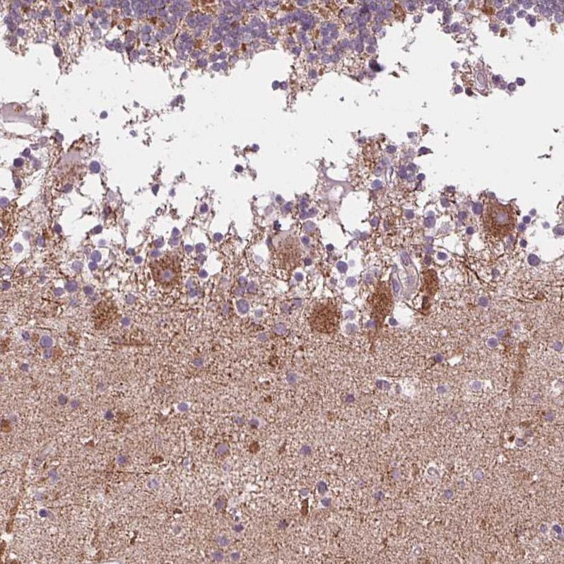 Immunohistochemical staining of human cerebellum shows moderate granular cytoplasmic positivity in Purkinje cells.